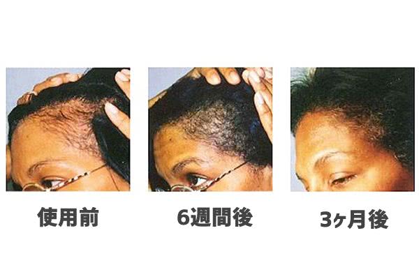 パントガールの前髪・生え際への効果（3ヶ月～6ヶ月後）