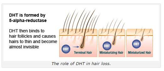 ヘアーオメガ・フォーム(セラム)はDHT阻害効果のあるミノキシジル育毛剤