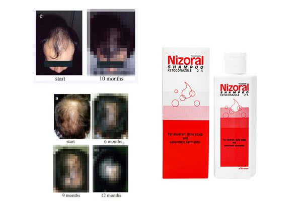 【画像】ニゾラールシャンプーの効果を写真つきで解析！フケや薄毛(AGA)対策にお勧め