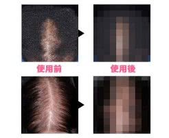 【画像】女性用ロゲイン2%の効果を写真つきで解説！発毛までの期間は？