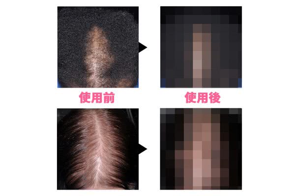 【画像】女性用ロゲイン2%の効果を写真つきで解説！発毛までの期間は？