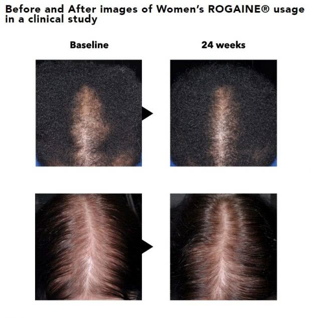 女性用ロゲインの効果を示した使用前後の写真の画像(6ヶ月後)